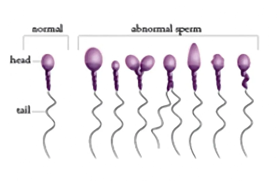 acupuncture for sperm abnormalities